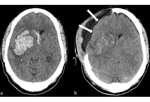 Post Operative Neurosurgery